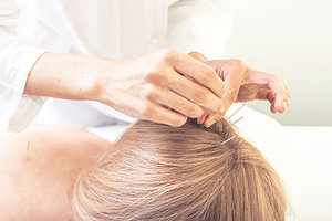 scalp acupuncture - Copyright – Stock Photo / Register Mark