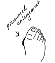 Illustration showing the pathology of sugar toes. - Copyright – Stock Photo / Register Mark