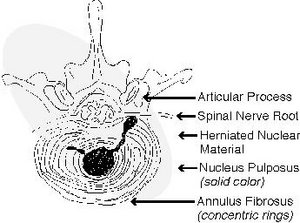 Herniated lumbar disc. - Copyright – Stock Photo / Register Mark