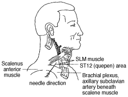 Illustration showing Needling in the area of ST12. - Copyright – Stock Photo / Register Mark