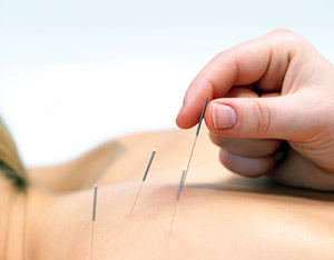 acupuncture - Copyright – Stock Photo / Register Mark