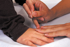 acupuncture - Copyright – Stock Photo / Register Mark