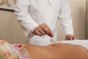 acupuncture - Copyright – Stock Photo / Register Mark