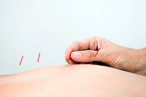 acupuncture - Copyright – Stock Photo / Register Mark