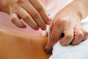 acupuncture - Copyright – Stock Photo / Register Mark