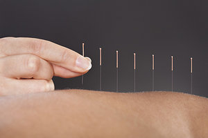 acupuncture needles - Copyright – Stock Photo / Register Mark