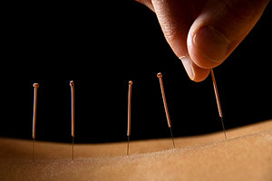 acupuncture needles - Copyright – Stock Photo / Register Mark