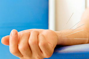 acupuncture needles - Copyright – Stock Photo / Register Mark