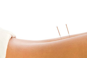 back acupuncture - Copyright – Stock Photo / Register Mark