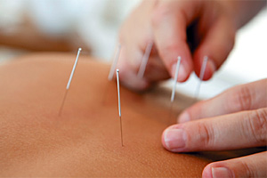 acupuncture needling - Copyright – Stock Photo / Register Mark