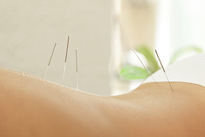 acupuncture treatment - Copyright – Stock Photo / Register Mark