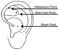 Anatomical locations of the shen men, relaxation and sham acupoints. - Copyright – Stock Photo / Register Mark