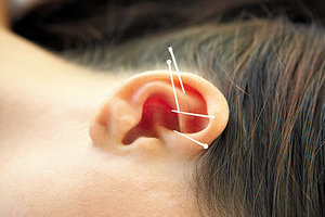 Auricular Acupuncture - Copyright – Stock Photo / Register Mark