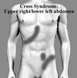 cross syndrome - Copyright – Stock Photo / Register Mark