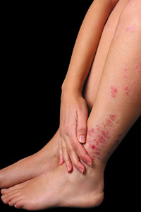 dermatitis - Copyright – Stock Photo / Register Mark