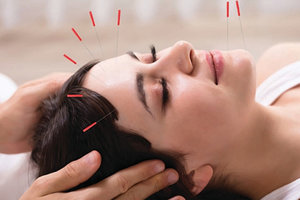 facial acupuncture - Copyright – Stock Photo / Register Mark