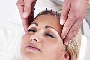 head acupuncture - Copyright – Stock Photo / Register Mark