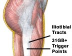 The illiotibial tract and location of GB31 and adjacent trigger points. - Copyright – Stock Photo / Register Mark