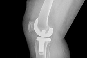 knee replacements - Copyright – Stock Photo / Register Mark