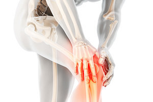 knee osteoarthritis - Copyright – Stock Photo / Register Mark