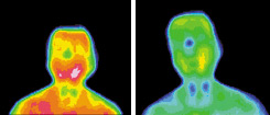 Infrared images for diabetes subject - Copyright – Stock Photo / Register Mark