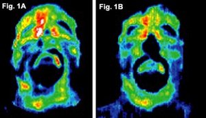 Before and after infrared images of the face of first volunteer. - Copyright – Stock Photo / Register Mark