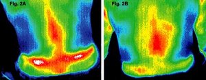 Before and after infrared images of the of the lower back of patient. - Copyright – Stock Photo / Register Mark