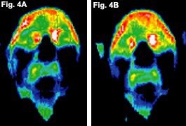 Before and after infrared images of the face of a patient. - Copyright – Stock Photo / Register Mark