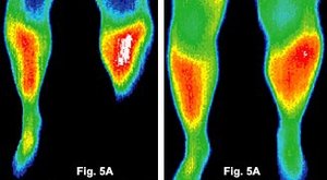 Before and after infrared images of the feet of a patient. - Copyright – Stock Photo / Register Mark