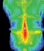 Infrared image of patient before treatment by acupuncture. - Copyright – Stock Photo / Register Mark