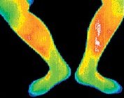 Thermogram of the inside of the left leg of a woman with liver cancer. - Copyright – Stock Photo / Register Mark