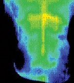 Infrared image of patient after being treated with electroacupuncture. - Copyright – Stock Photo / Register Mark