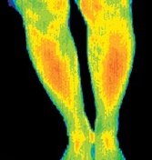 Thermogram of a woman with a digestive problem. - Copyright – Stock Photo / Register Mark