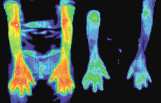 Infrared images of a woman with arthritis. - Copyright – Stock Photo / Register Mark