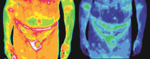 Infrared images of a male with prostate cancer. - Copyright – Stock Photo / Register Mark