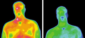 Infrared images for migraine patient - Copyright – Stock Photo / Register Mark