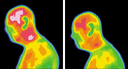 Infrared images for subject brain tumor - Copyright – Stock Photo / Register Mark