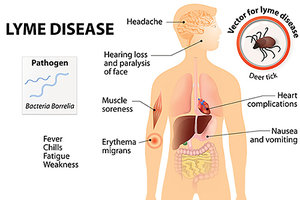 lyme disease - Copyright – Stock Photo / Register Mark