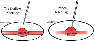 needling - Copyright – Stock Photo / Register Mark