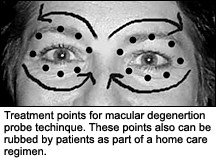 Treatment points for macular degeneration probe technique. - Copyright – Stock Photo / Register Mark