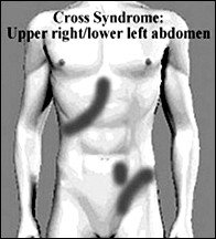 Illustration of Cross Syndrome. - Copyright – Stock Photo / Register Mark